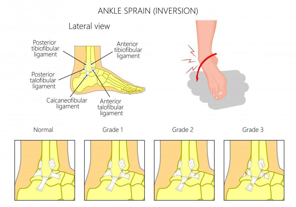 ankle injury